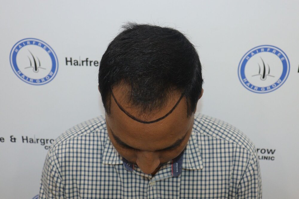 hair line marking before transplant.JPG