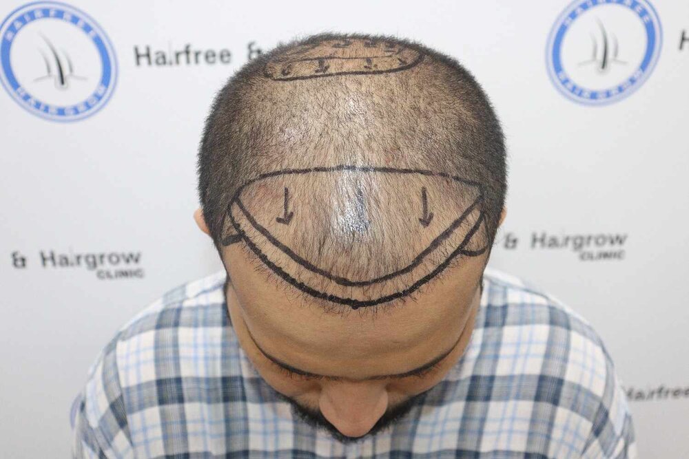hair line marking.JPG