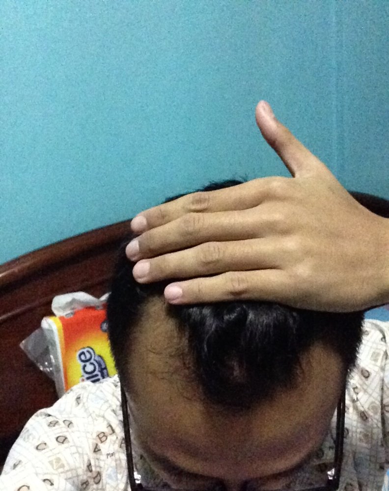 hair loss - 1 Feb 2017.JPG