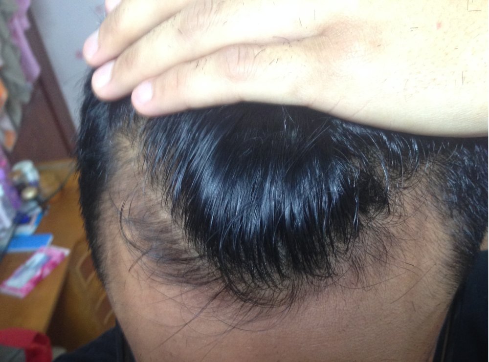 hair loss - 10 June 2017.JPG