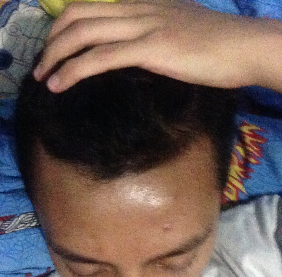 hair loss - 23 Nov 2014.JPG