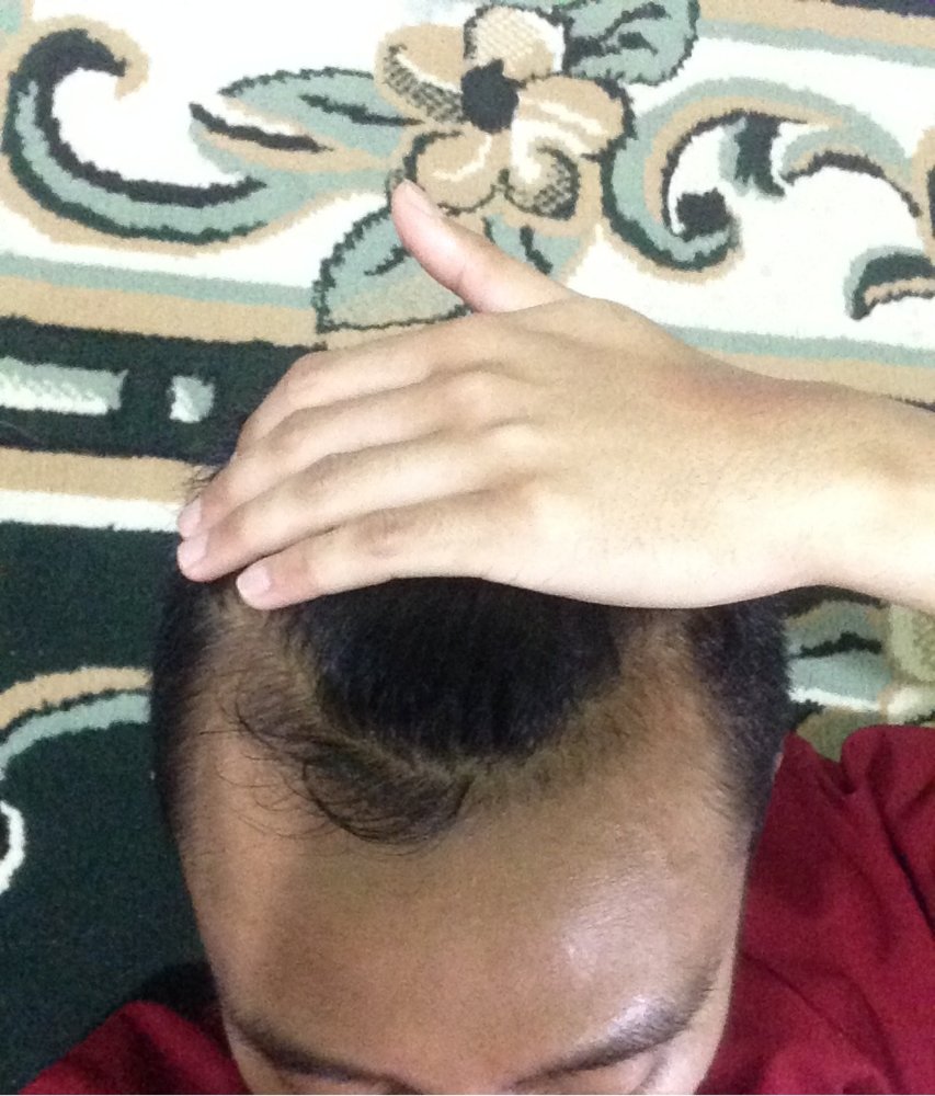 hair loss - 29 June 2017 (1 Month dutasteride).JPG