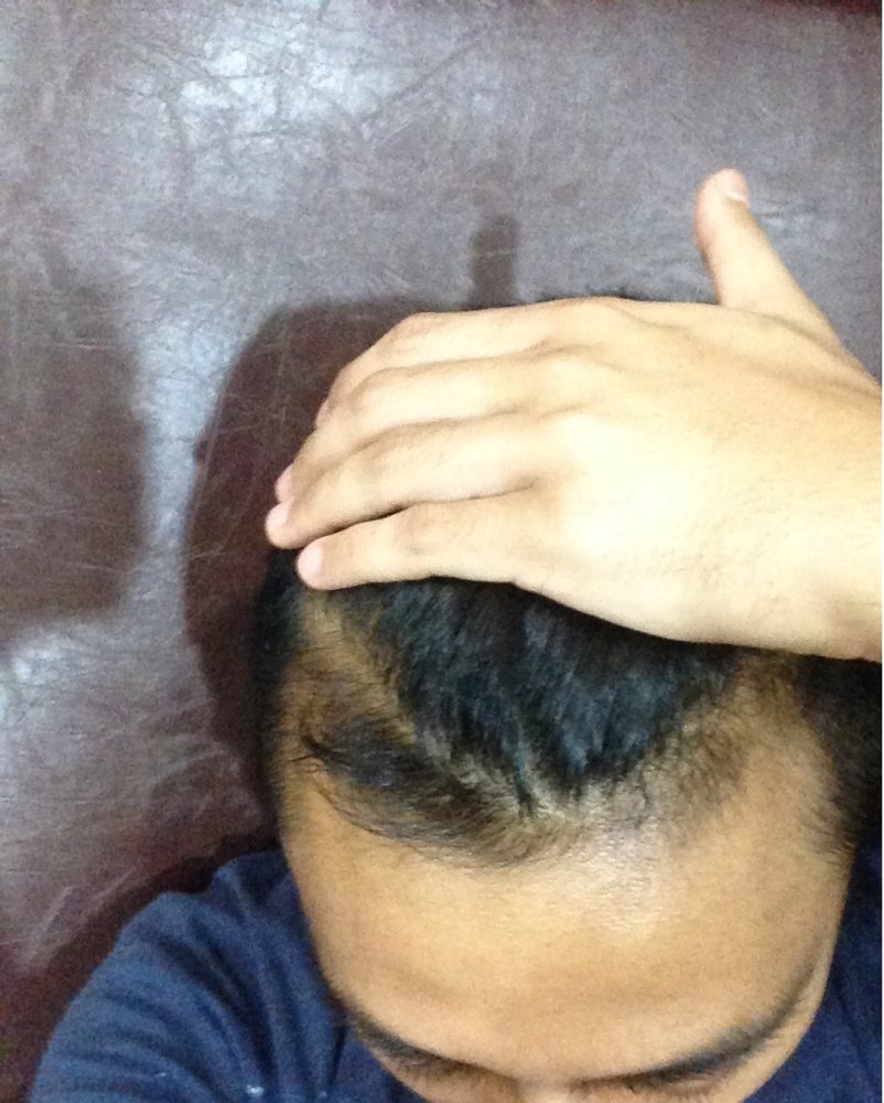 hair loss - 5 Aug 2017.jpg