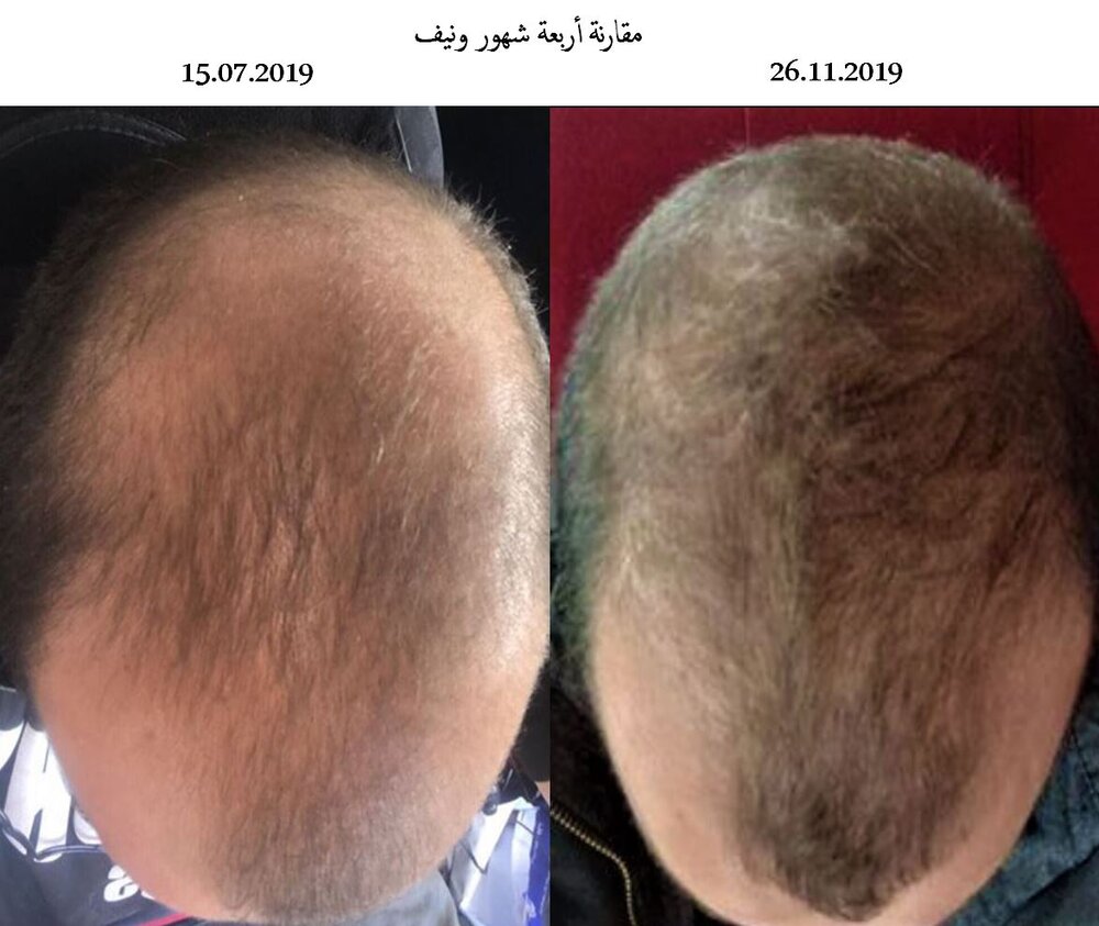 Hair loss.jpg