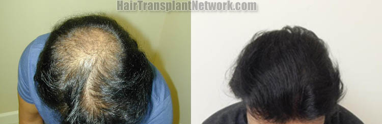 hair-replacement-top-175027.jpg