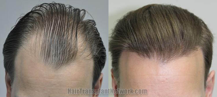 hair-restoration-photos-top-178258.jpg