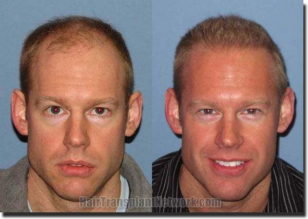 hair-restoration-pshapiro-before-and-after-6mth-front.jpg