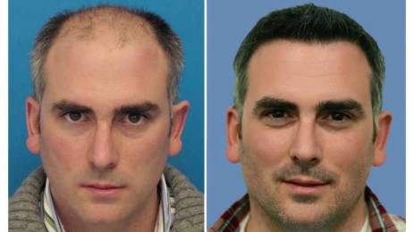 hair-transplant-650161903.jpg