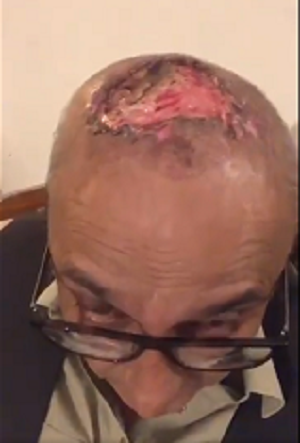 Hair-Transplant-Gone-Wrong.png