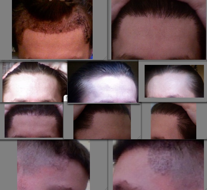 hair transplant pic.jpg