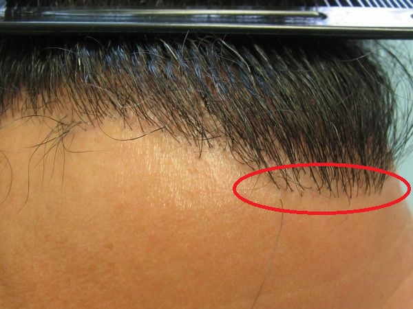 hair-transplant-repair-9.jpg