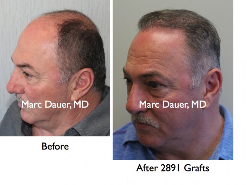 hair-transplant-slides5-157.jpg