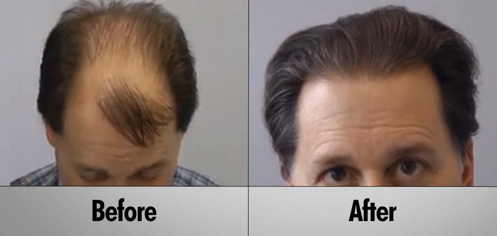 hair-transplant-thumb4.jpg