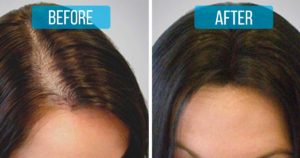 hair_loss_treatment_featured-300x158-jpg.jpg