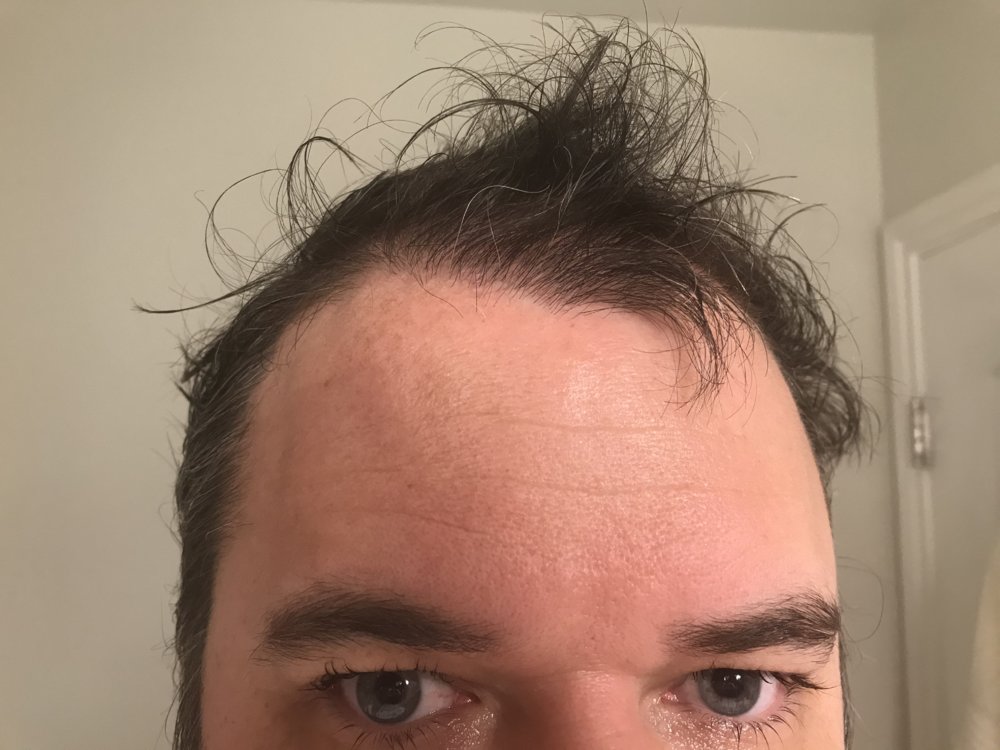 Hairline.JPG