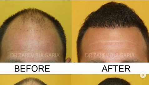 hairline-zarev.png