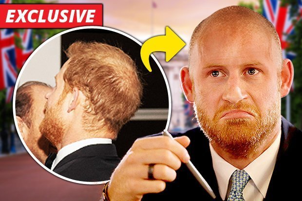 How-Prince-Harry-looks-bald-761377.jpg