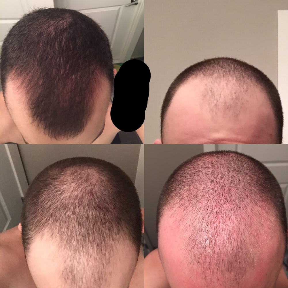 avodart hair loss