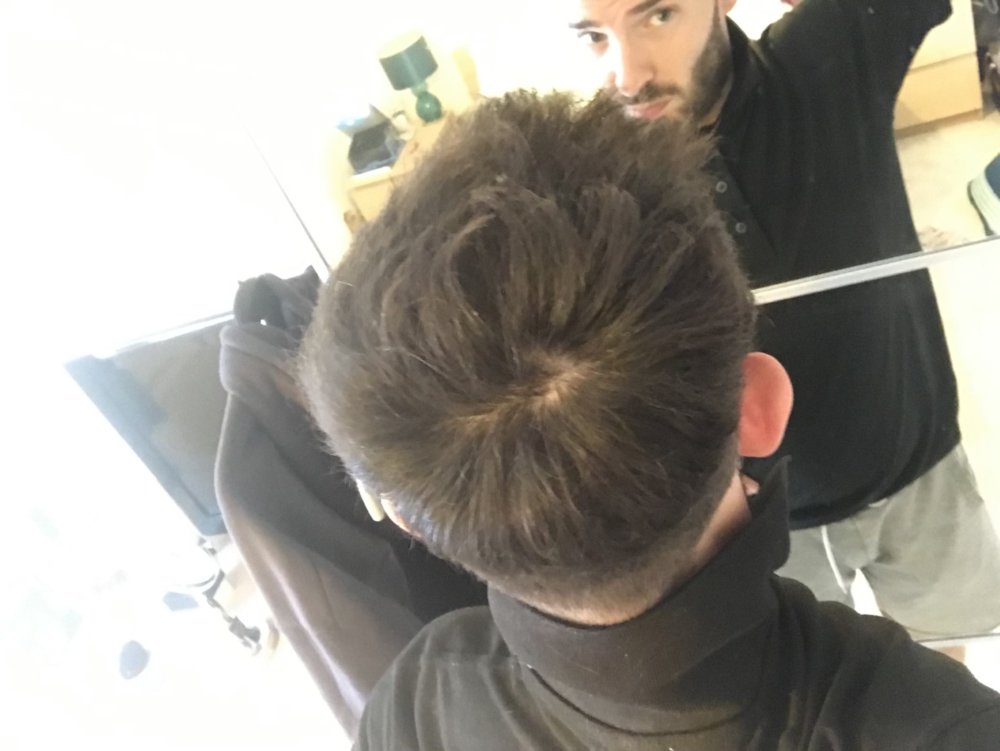 Thinning Crown Or Normal Crown? Please Advise HairLossTalk Forums