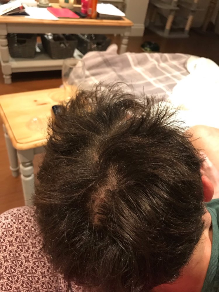 Thinning Crown Or Normal Crown? Please Advise HairLossTalk Forums
