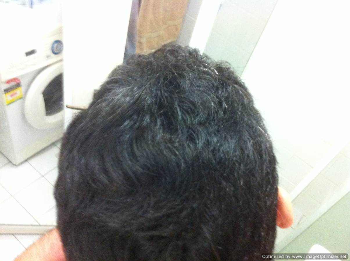 start age finasteride to