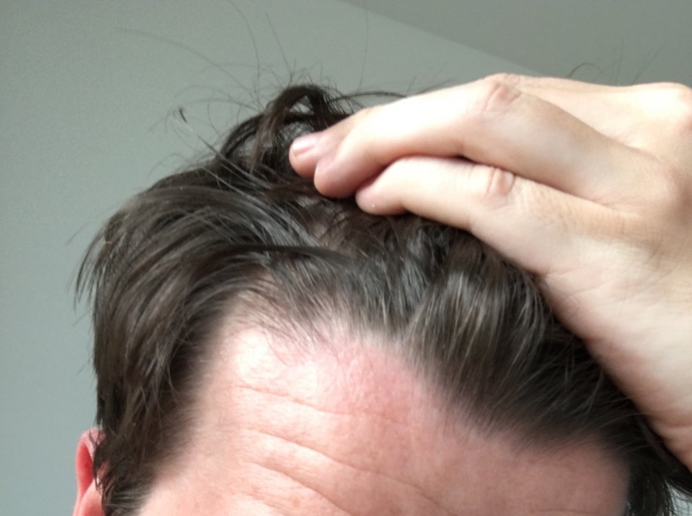 How To Thicken Or Regrow This Hairline Hairlosstalk Forums