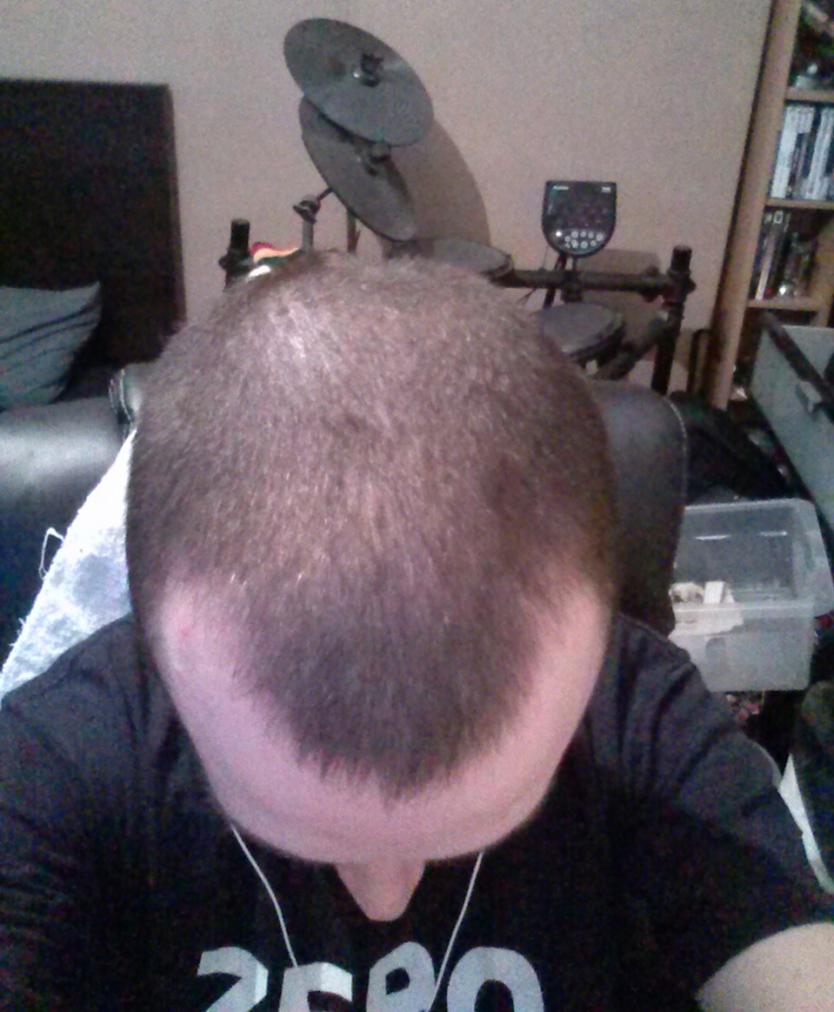 Tempted To Shave Head Hairlosstalk Forums