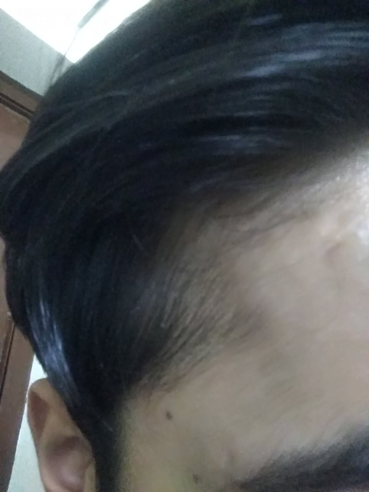 Identifying Pattern 20 Year Old Male | HairLossTalk Forums