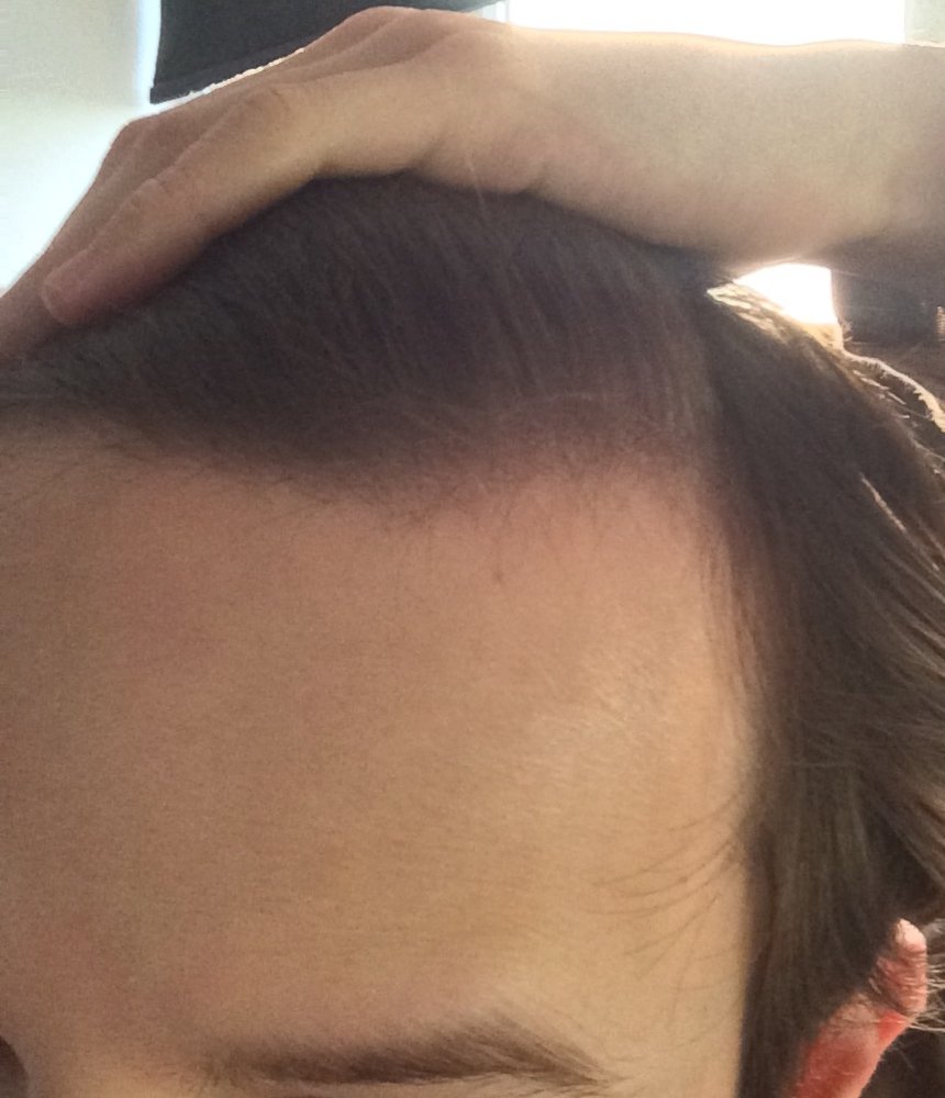 Is My Crown Thinning Am I Balding And Is Losing A Few Short Hairs