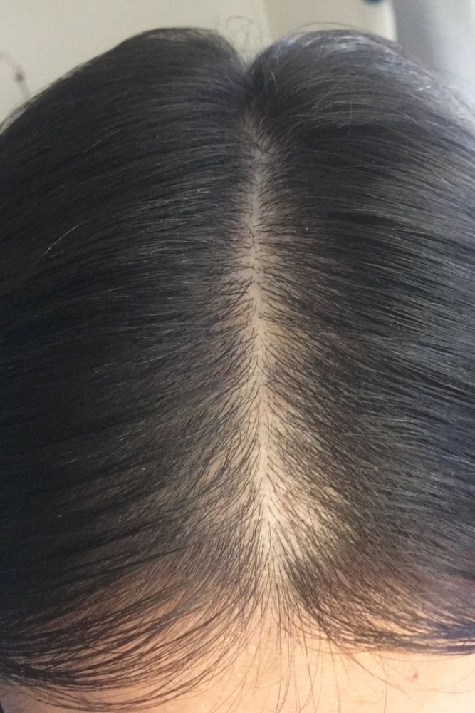 can rogaine regrow bald spots