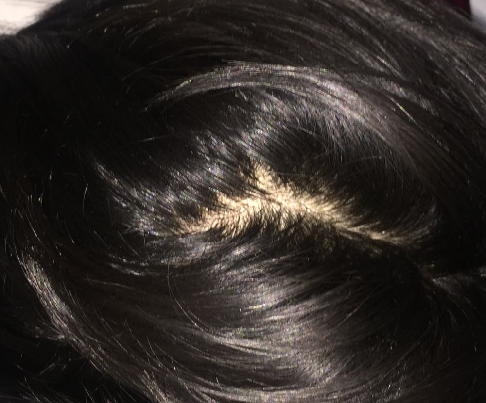 Is This Just A Part Or Is The Top Thinning? | HairLossTalk Forums