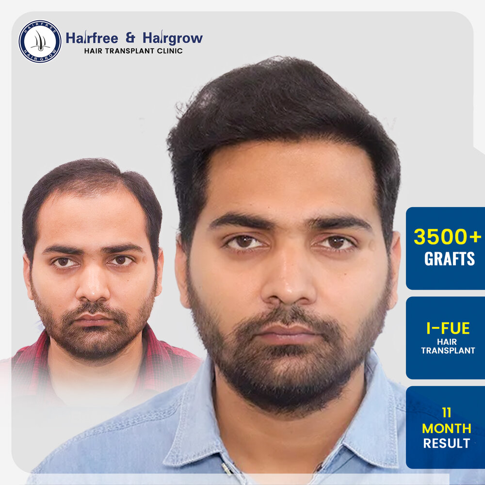 karan-agarwal-hair-transplant-result-pune-3500-grafts-i-fue-11-month.jpg.jpg