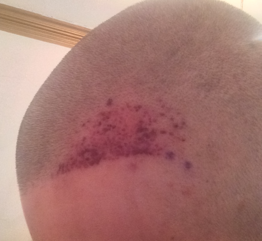 Left Side TP1 day 2.png