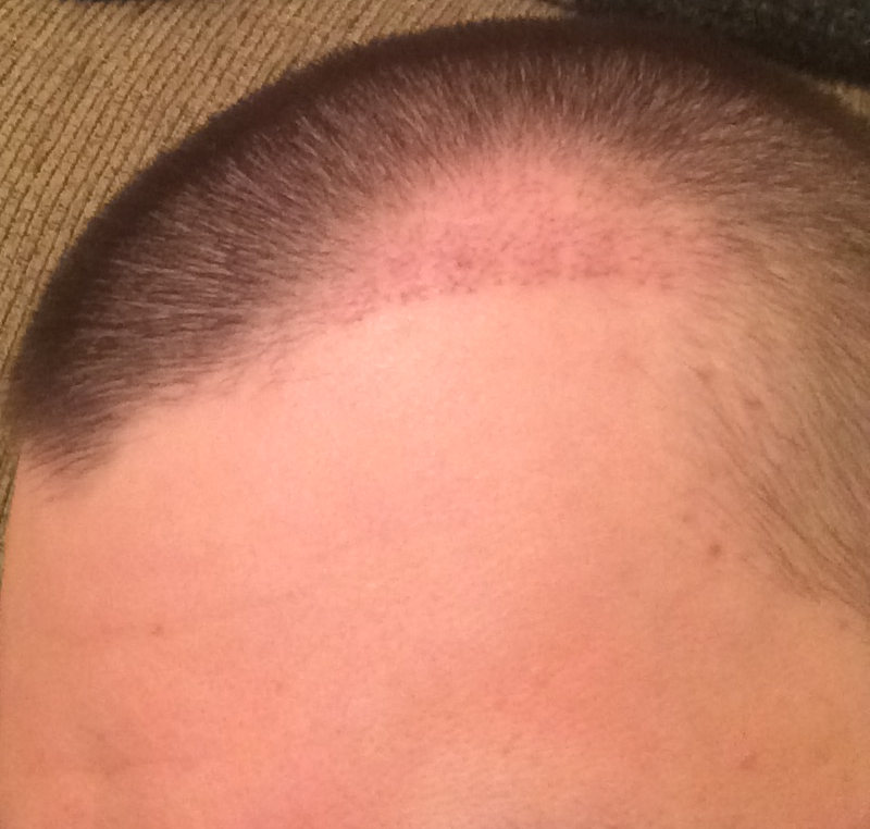 LeftSide TP1 3 weeks.png