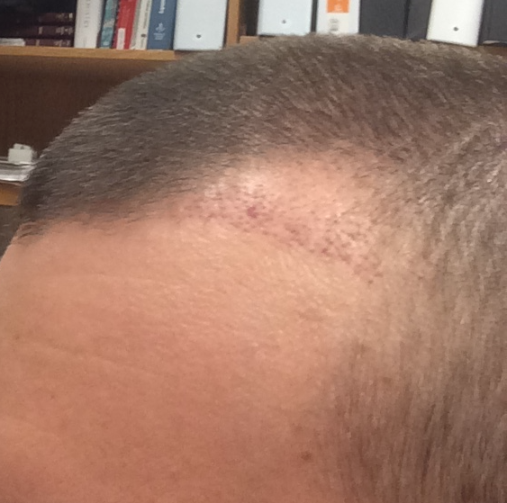 LeftSide TP1 3 weeks2.png