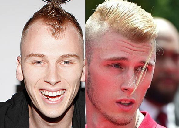 machine-gun-kelly-hair-transplant-before-and-after.jpg