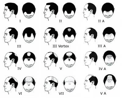 male-pattern-baldness-stages-illustration.jpg