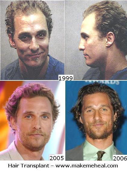 matthew-mcconaughey-hair-transplant-jpg.jpg