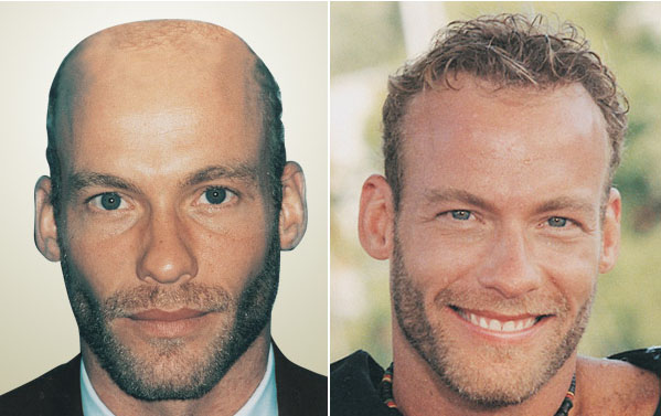 men-hair-transplant-results-09.jpg