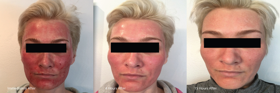 Microneedle-transistion-Charlotta.jpg