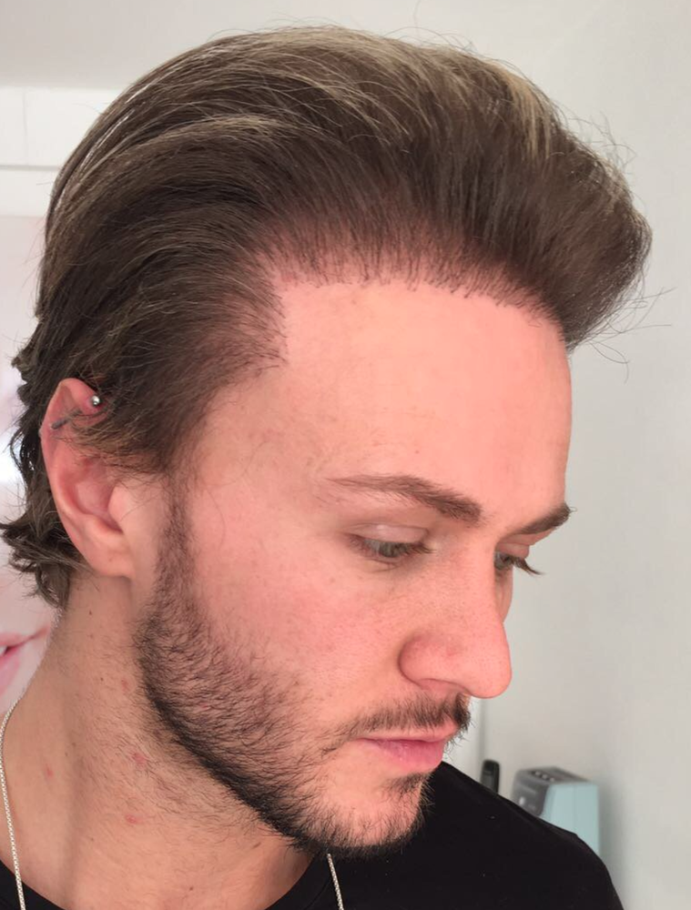 natural-hairline-bad-celebrity-hair-transplant-png.png