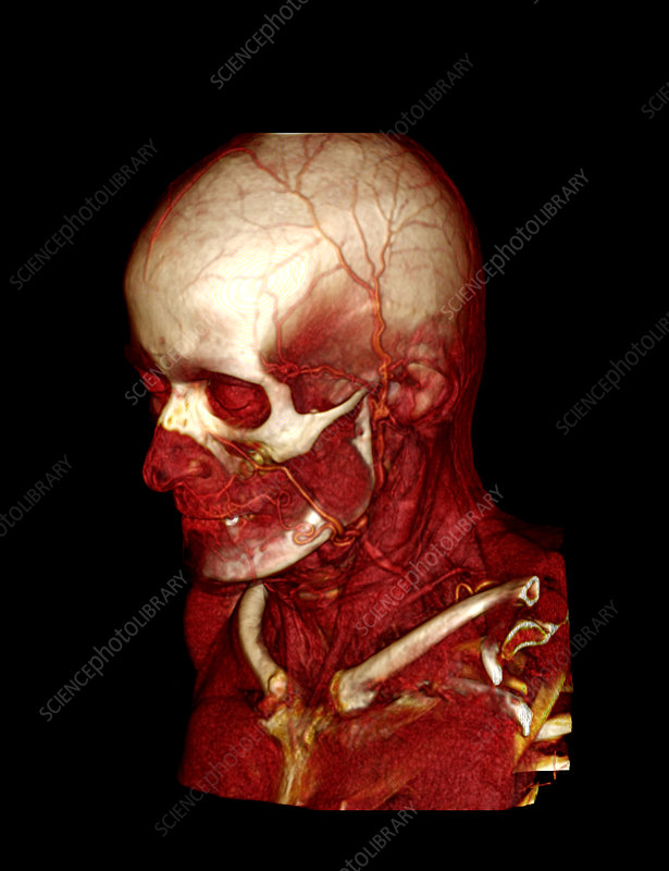 P1200228-Human_head_and_neck,_CT_scan.jpg