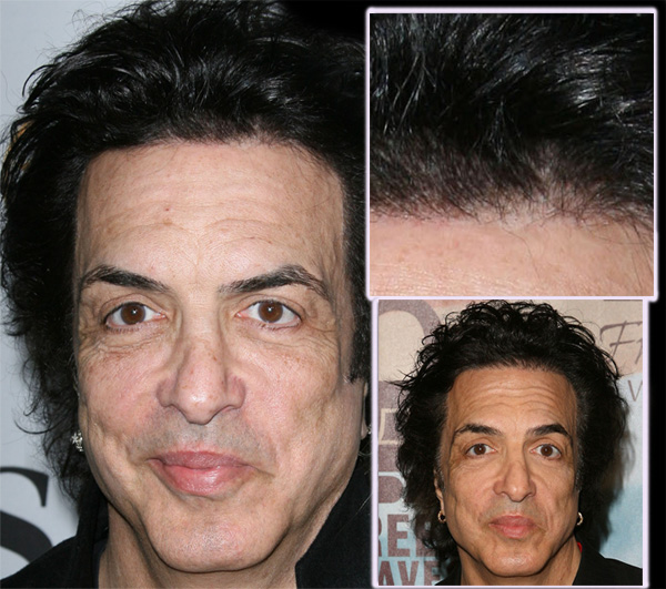 paul-stanley-before-and-after.jpg