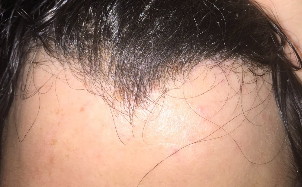 week 1 shedding finasteride after