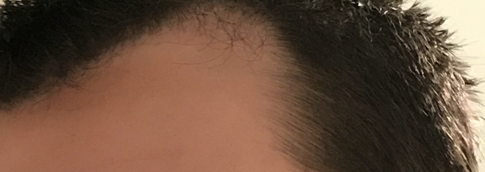 Pre TP2 left side.png