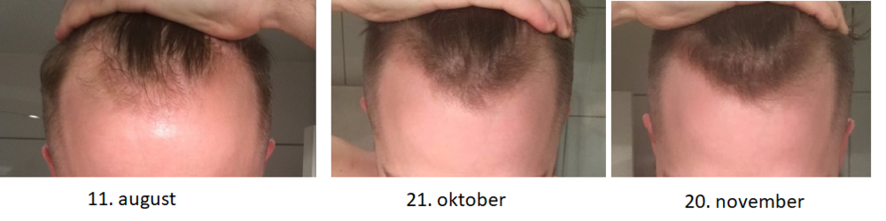 progresjon 3 mnd minoxidil.png