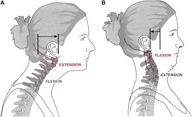 protactionextension.jpg