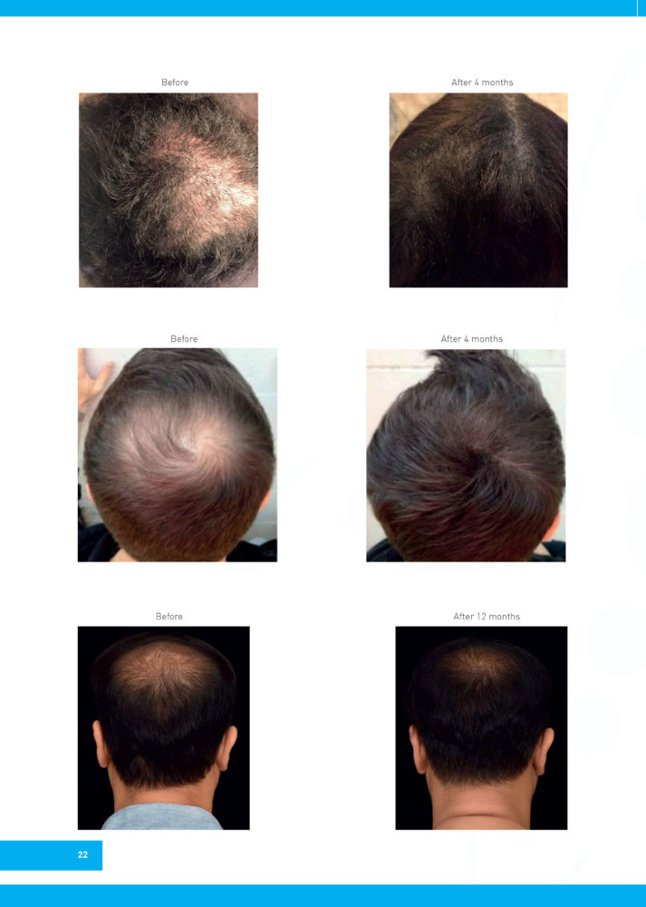 Regenera-Activa-before-after-1.jpg