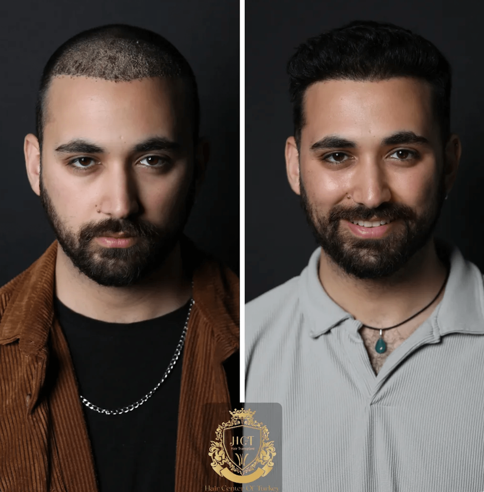 Results Hair Center of Turkey.png