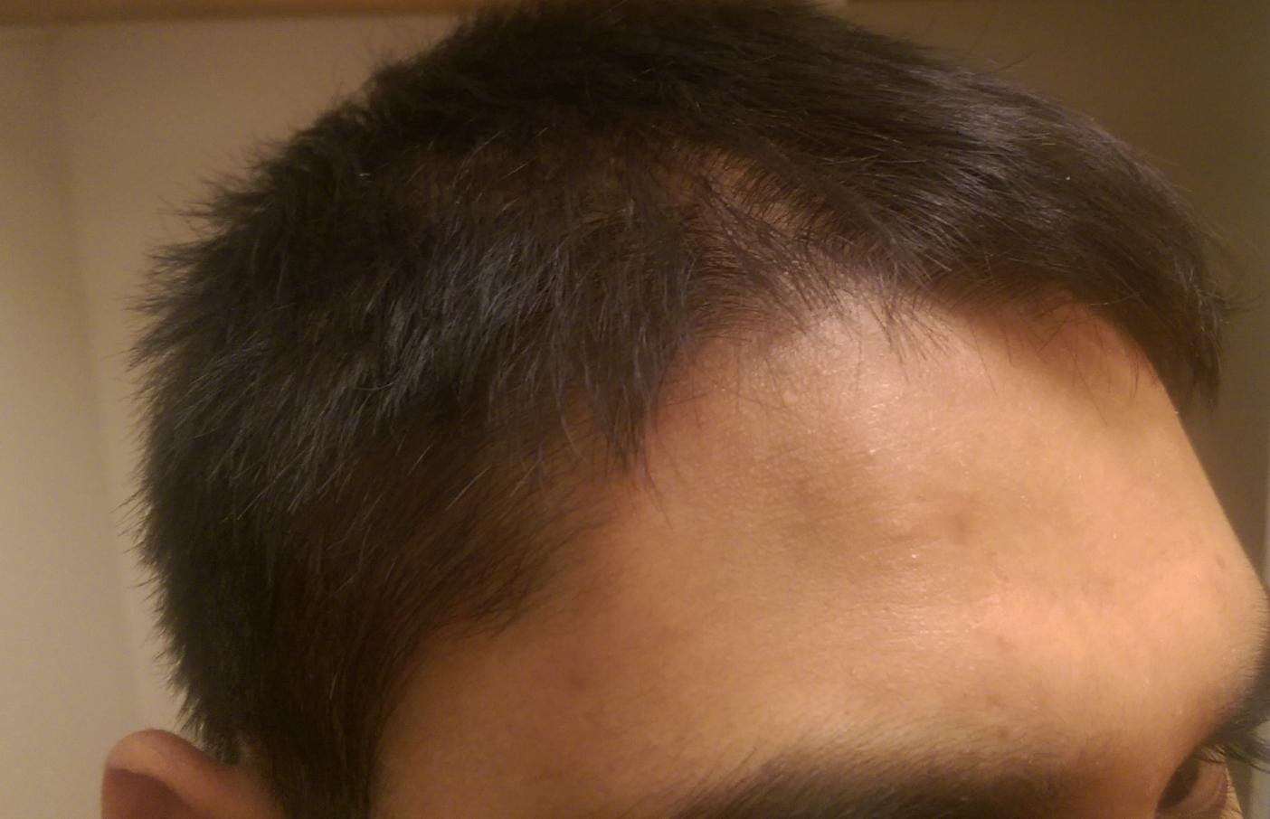 Thinning Crown Temple At 23 Treatment Advice Opinions Hairlosstalk Forums